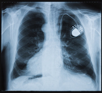 Implantable Defibrillators with Faulty Batteries Lead to Class Action