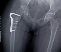 Fosamax and Femur Fractures