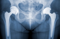 Canadian Attorney Files DePuy Class Action