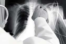 Asbestos diseases lung cancer