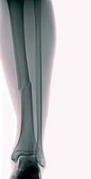 Tibia Fracture