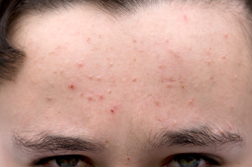New Zealand Firm Targets US Acne Market to Fill Void Left by Pulled Accutane Medication