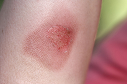 infected burn blister