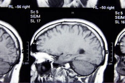 Lawsuit over denied insurance claim for brain injury
