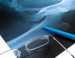 California Man Suffers from DePuy Orthopaedics Hip Implant