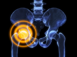 DePuy Hip Replacement "Poster Lady" Sues