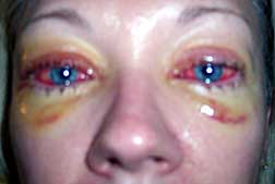 Infección ocular causada por la solución para lentes de contacto ReNu