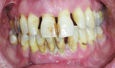 toothdecay2