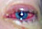 infected eye