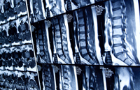 Back and Neck Injury: Insist on MRI