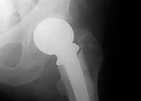 Wright Conserve—Latest Hip Implant to Disappoint