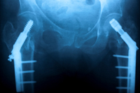 Zimmer Hip: "I Don't Blame My Orthopedic Surgeon"