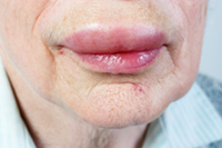 Lisinopril Associated with Many Serious Side Effects, Including Angioedema and Liver Damage