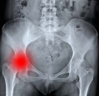 Stryker Orthopaedics  Rejuvenate Modular Hip System Recall Compensation on the Way
