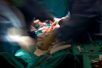 Angioplasty TVAM, Doctors and the FDA