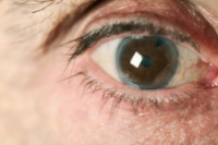 Avastin Injection Helps Eyes, Comes with Side Effects
