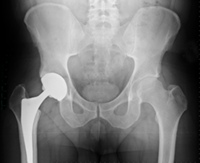 Panel de la FDA Revisara los reemplazos de cadera metal-metal