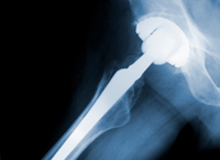 Honolulu Woman Sues over Faulty DePuy Hip Replacement