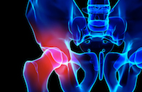 Defective Hip Litigation Continues On against Zimmer, Smith & Nephew
