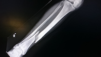 Are Risk of Invokana and Invokamet Bone Fractures a Sign of Fractured Regulations?