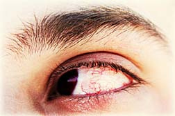 AMO bloodshot eye