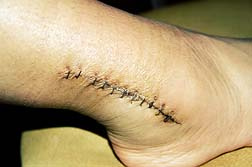 Ankle Surgery