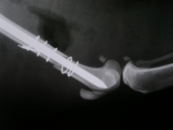 Fosamax femur fracture