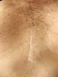 Guidant sugery scar