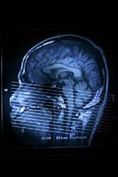 MRI Dyes brain scan