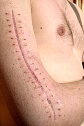 Panacryl victim scar
