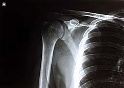 Shoulder X-Ray