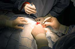 Trasylol Surgery