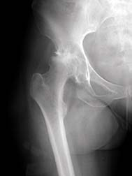Hip X-Ray