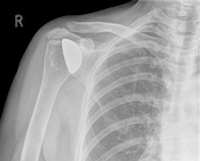 Zimmer Biomet Shoulder Failure: Consider Rehabilitation over Revision Surgery