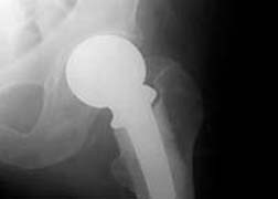 Arizona Man Launches Hip Replacement Lawsuit against Wright