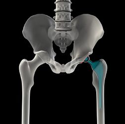 Will Hip Implant Lawsuit Awards in the US Affect Patients in Canada?