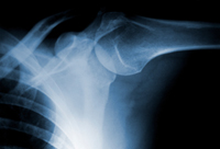 What's Causing Shoulder Pain Pump Injury? 