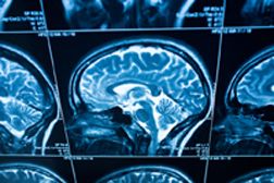 ER Traumatic Brain Injury Visits on the Rise