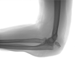 Nexium Fracture Claim Accepted by Attorney