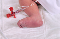 M Settlement San Diego Infant Permanently Injured by Negligent NICU Staff