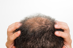 Propecia Side Effects: Is Hair Restoration for Erectile Dysfunction a Fair Trade?