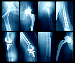 Hip & Knee Replacement Implant Failure Always a Possibility