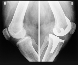 Study: Zimmer NexGen Knee Replacement Could Last Longer Than Thought