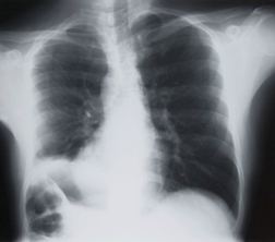 Researchers: Possible Link between IPF and Asbestosis