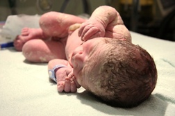 Hypospadias Listed as One of Many Dangerous Depakote Birth Defects