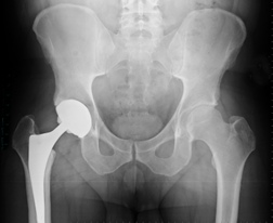 Stryker Recall Alert for Hip Implant Patients