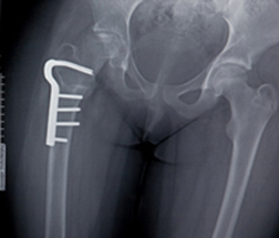 New Canadian Study Reveals Concern for Thighbone Fracture with Bone Drugs
