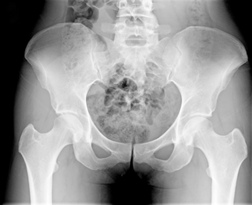 DePuy Faces Hip Implant Lawsuits