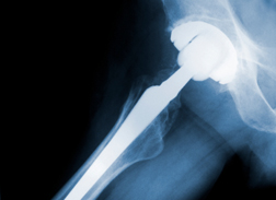 Study Backs Claims of Hip Replacement Problems