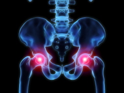 DePuy Orthopaedics Patient Suffers Fluid Buildup from Faulty DePuy Hip